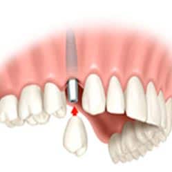 Teeth Replacement Options