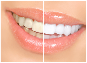 Teeth Whitening