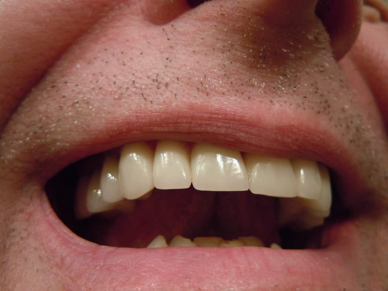 Do I Need a Dental Crown | Merion Village Dental