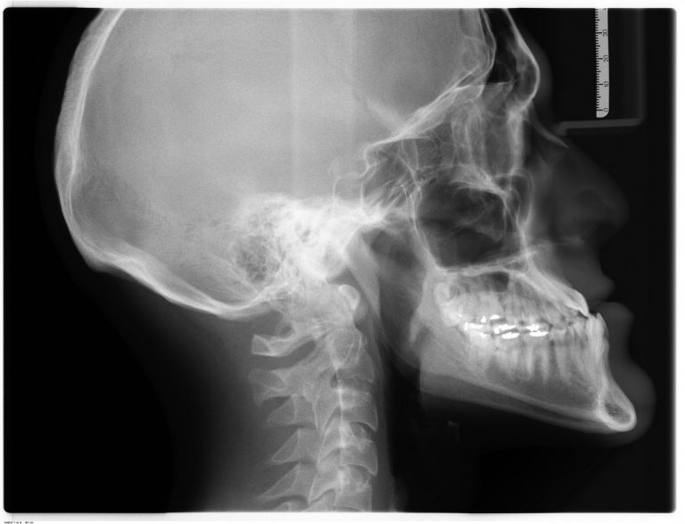xray merion uncover