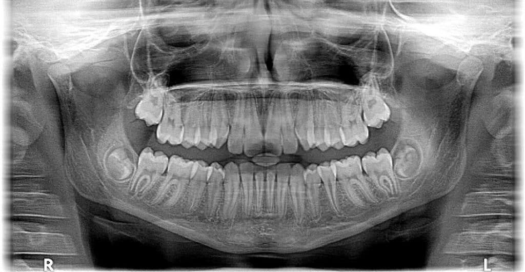 Dental Xray Example