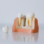 Wisdom Teeth Removal In Columbus Ohio