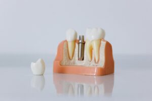 Wisdom Teeth Removal In Columbus Ohio